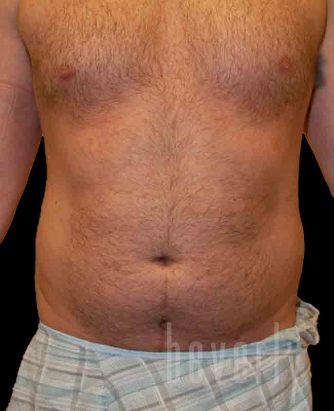 Case--4259 | Before Abdominal Etching/Male Liposuction