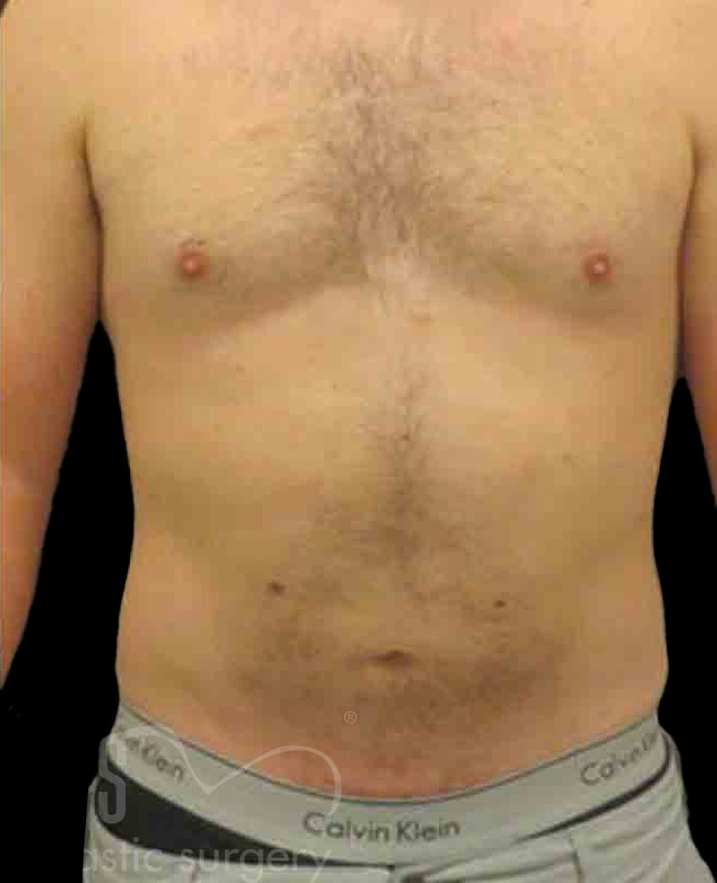 Case--5139 | After Abdominal Etching/Male Liposuction