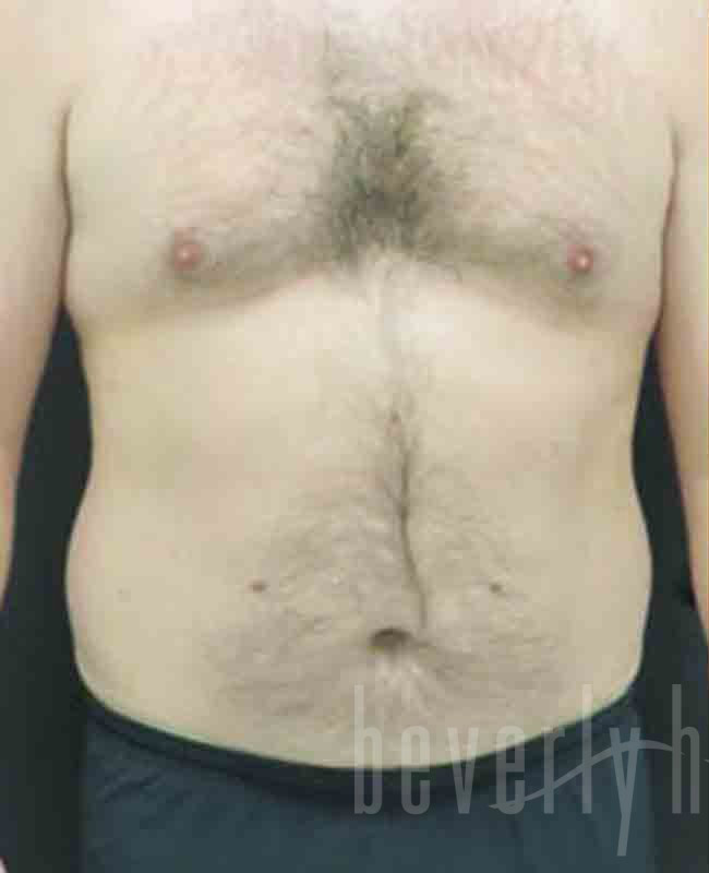 Case--5139 | Before Abdominal Etching/Male Liposuction