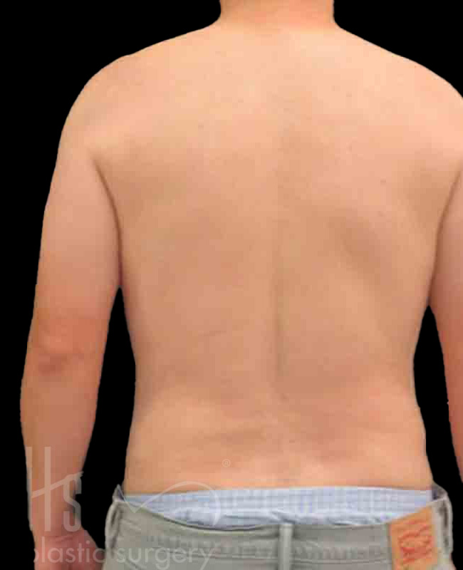 Case--3918 | After Abdominal Etching/Male Liposuction