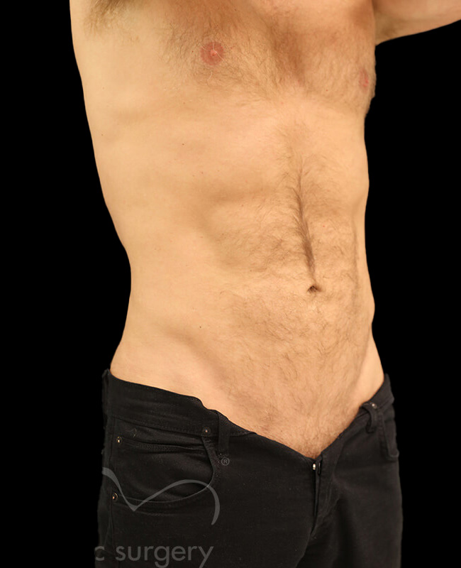 Case--5191 | After Abdominal Etching/Male Liposuction 2