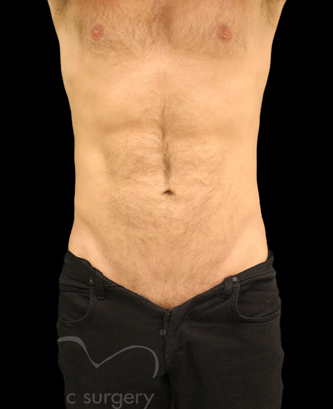 Case--5191 | After Abdominal Etching/Male Liposuction