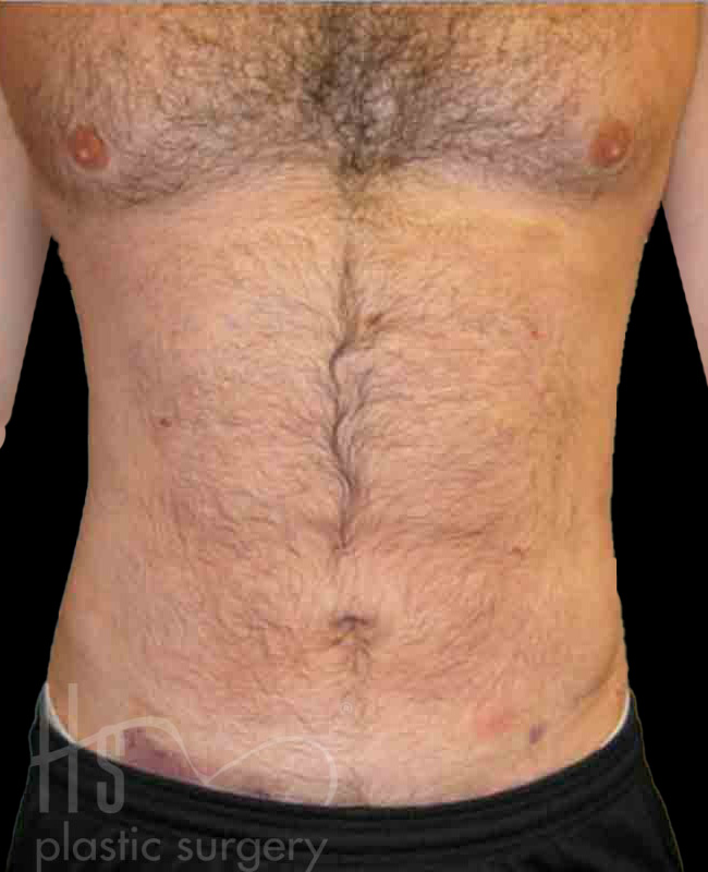 Case--1529 | After Abdominal Etching/Male Liposuction