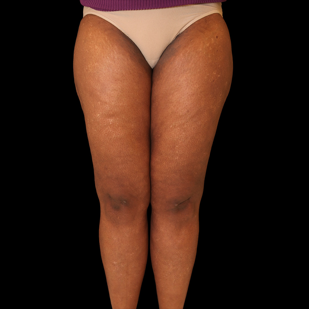 Case--8135 | After Thigh Lift