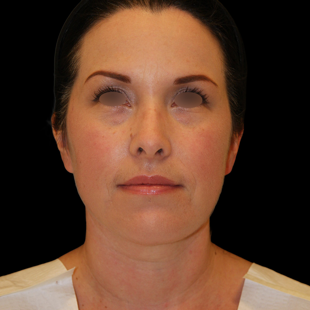 Case--3876 | After Face Liposuction