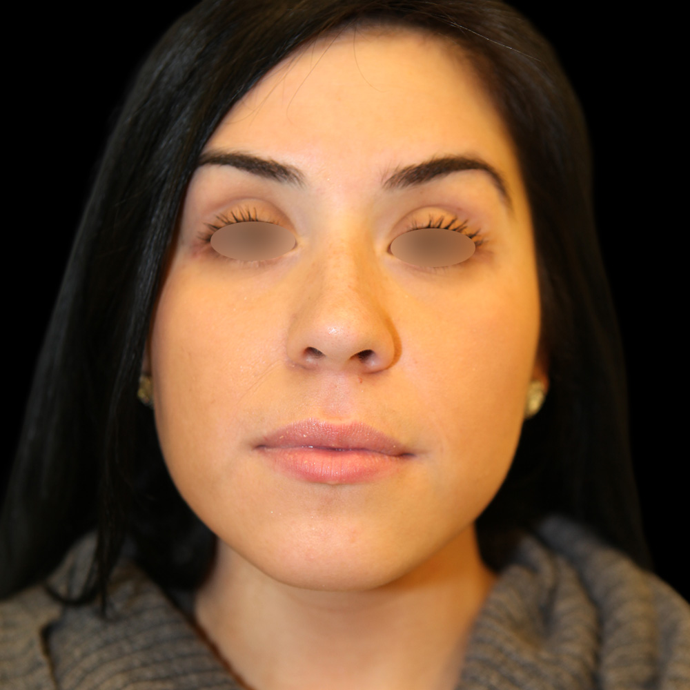 Case--6019 | After Face Liposuction