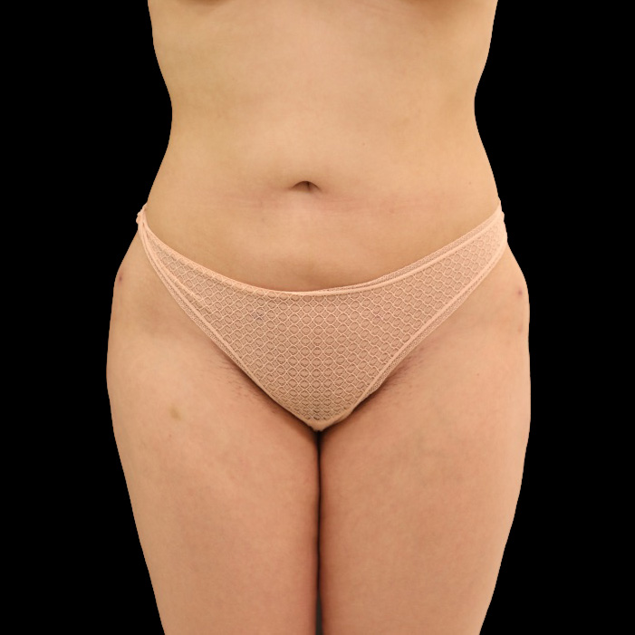 Case--9300 | After Brazilian Butt Lift 2
