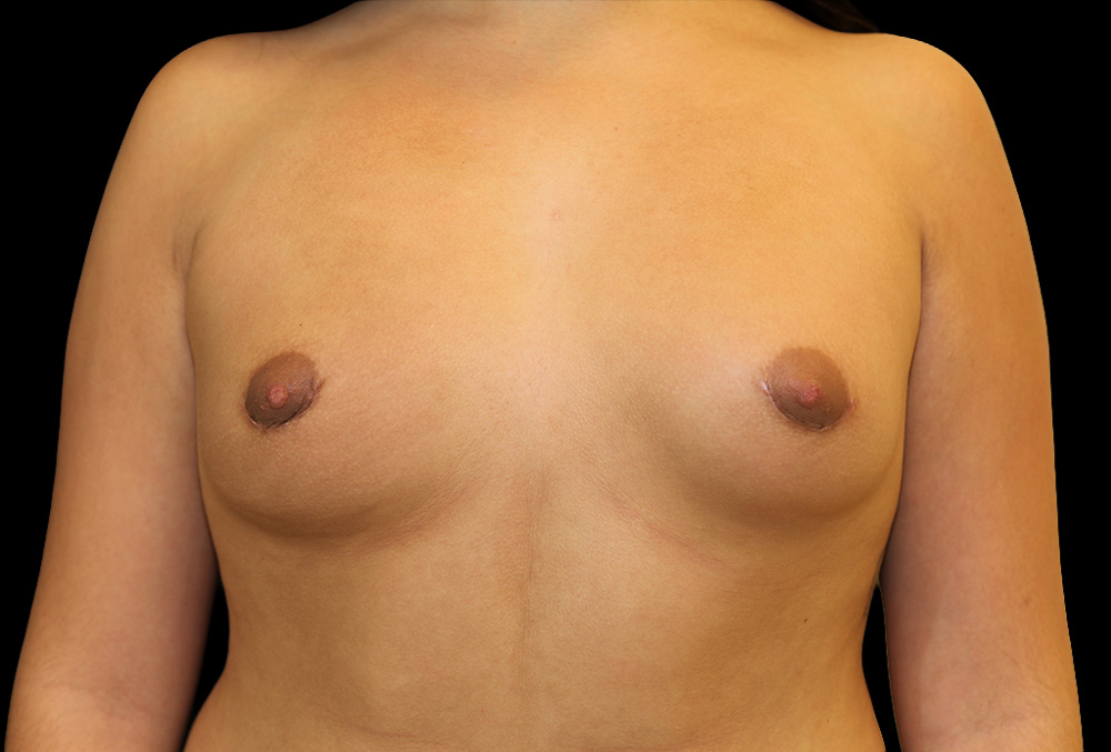 Case--2128 | After Breast Implant Removal