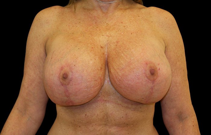 Case--9041 | After Capsulectomy