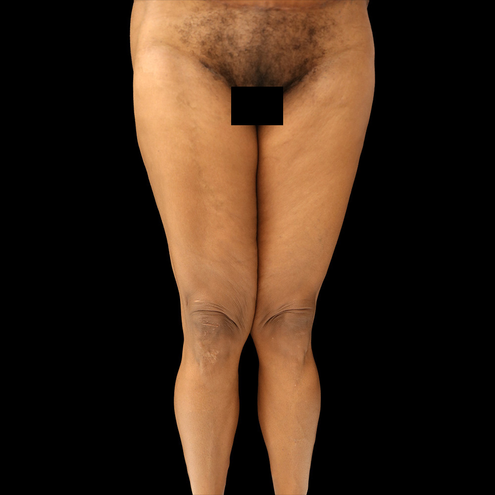 Case--4744 | After Thigh Lift