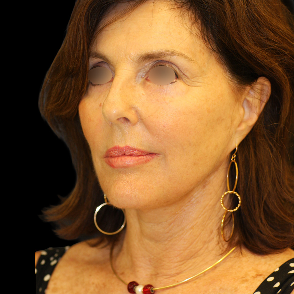 Case--9821 | After Face and Neck Lift 2