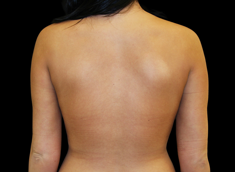 Case--2986 | After Body Liposuction