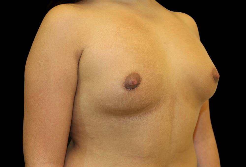Case--2128 | After Breast Implant Removal 2