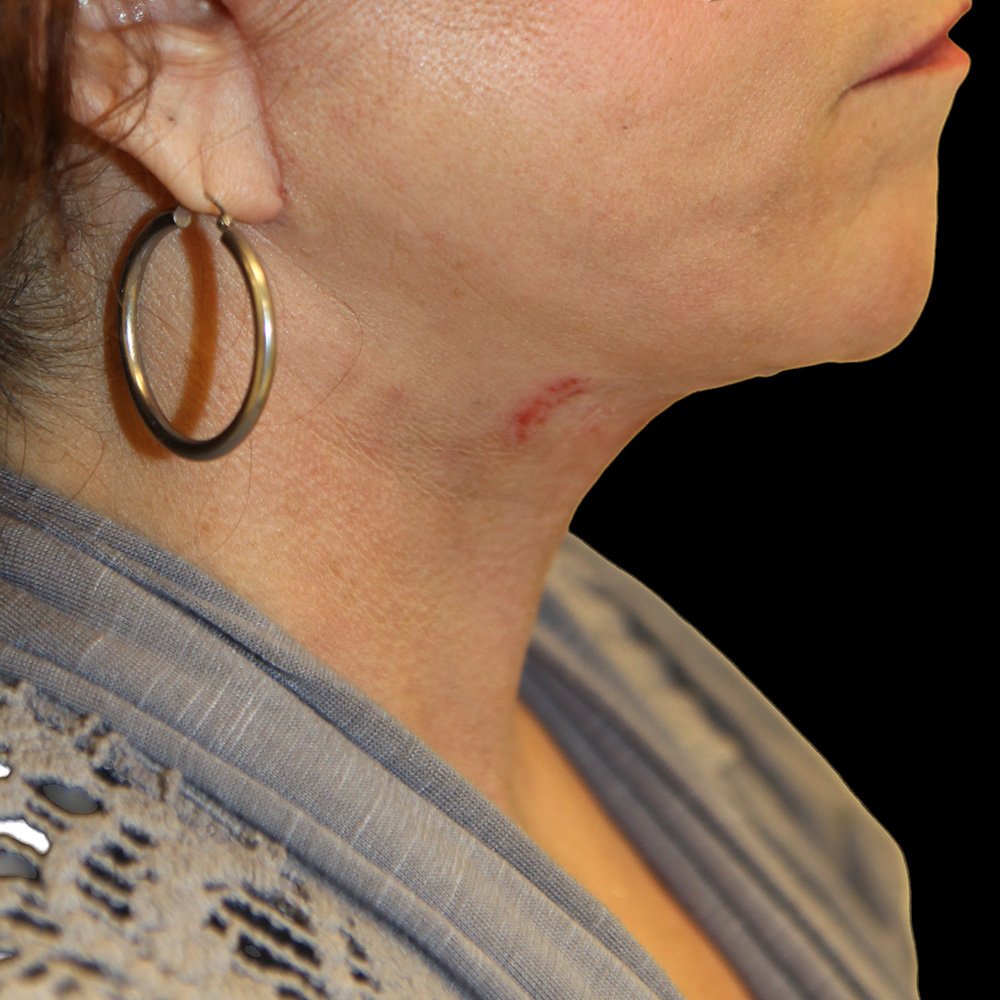 Case--6817 | After Neck Lift