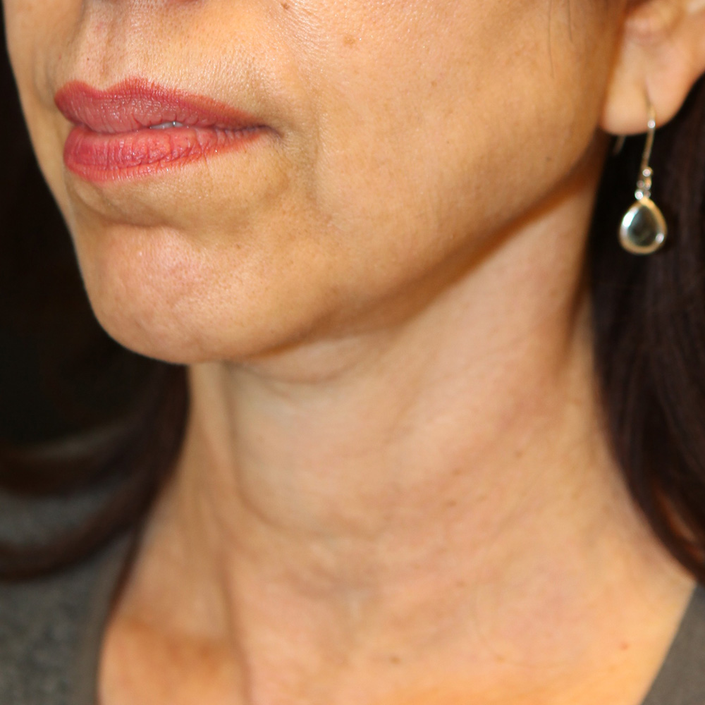 Case--2990 | After Neck Lift 2