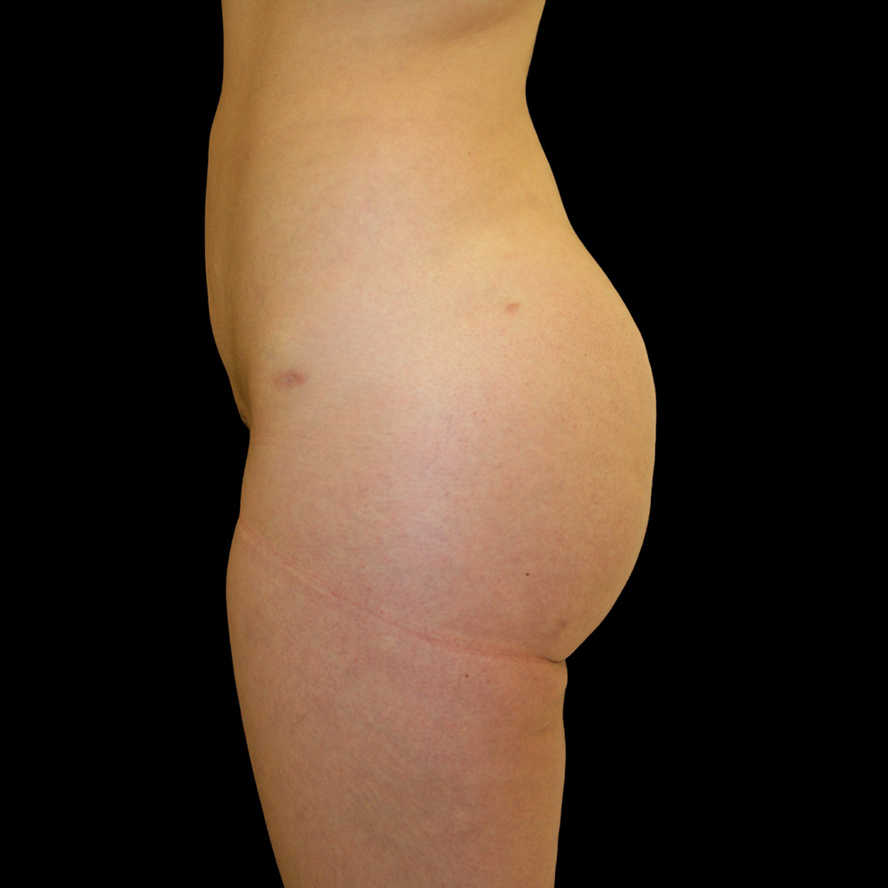 Case--9733 | After Brazilian Butt Lift 4