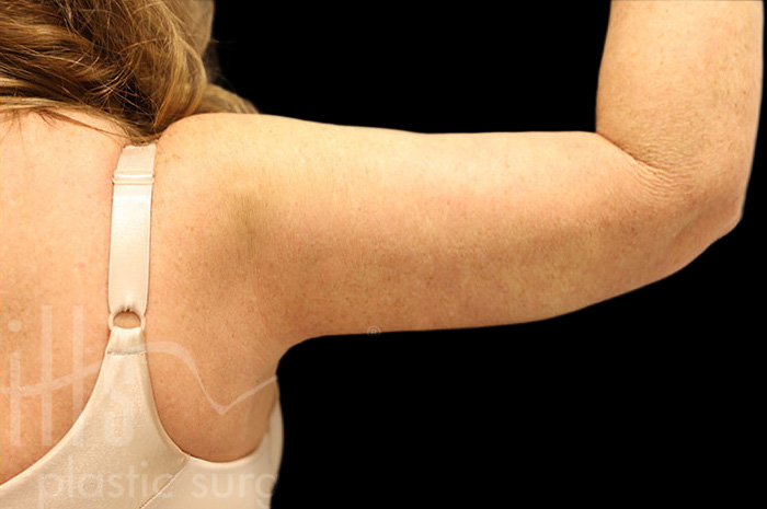 Case--2122 | After Body