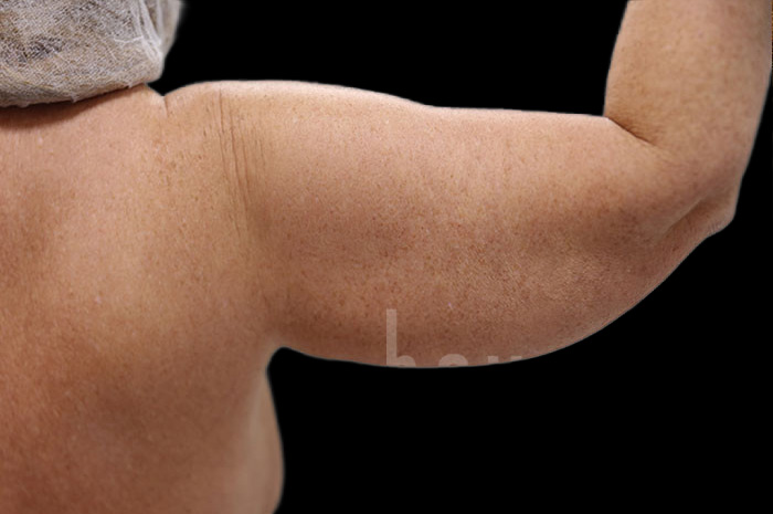 Case--2122 | Before Body