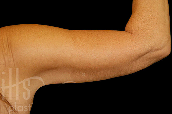 Case--9672 | After Body