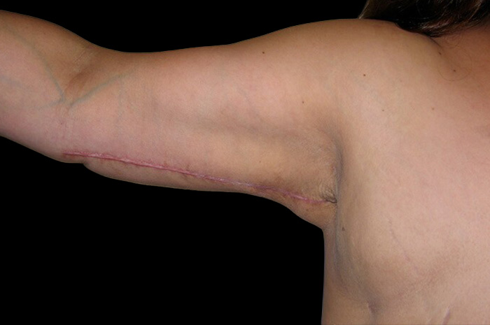 Case--4985 | After Arm Lift 2