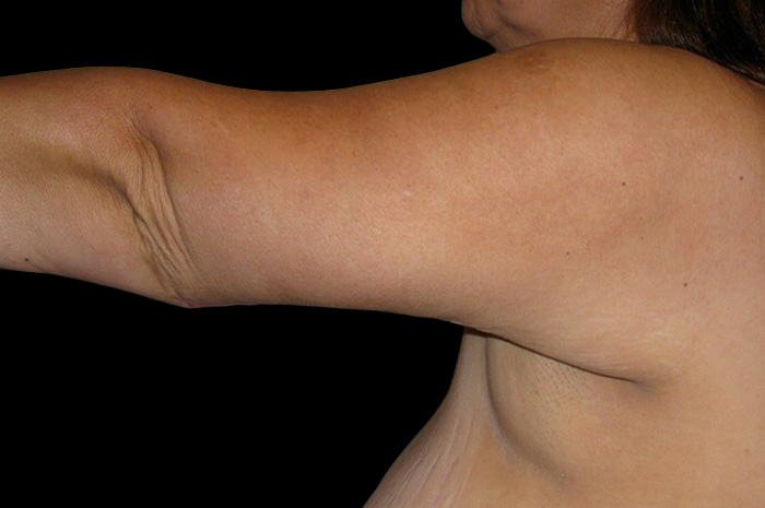 Case--4985 | After Arm Lift 4