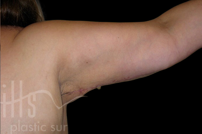 Case--4985 | After Body