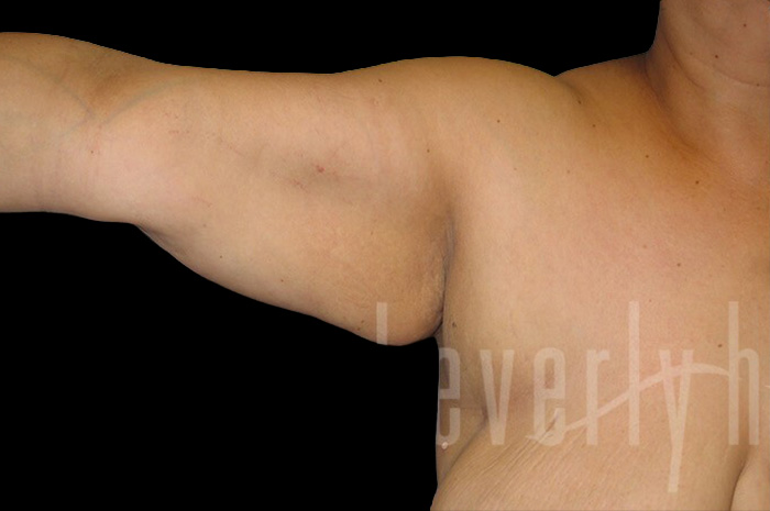 Case--4985 | Before Arm Lift 2