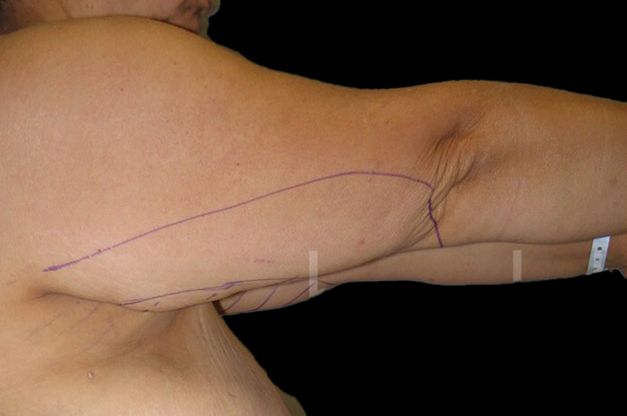 Case--4985 | Before Arm Lift 3