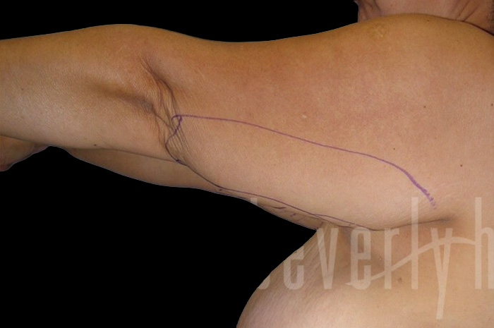 Case--4985 | Before Arm Lift 4