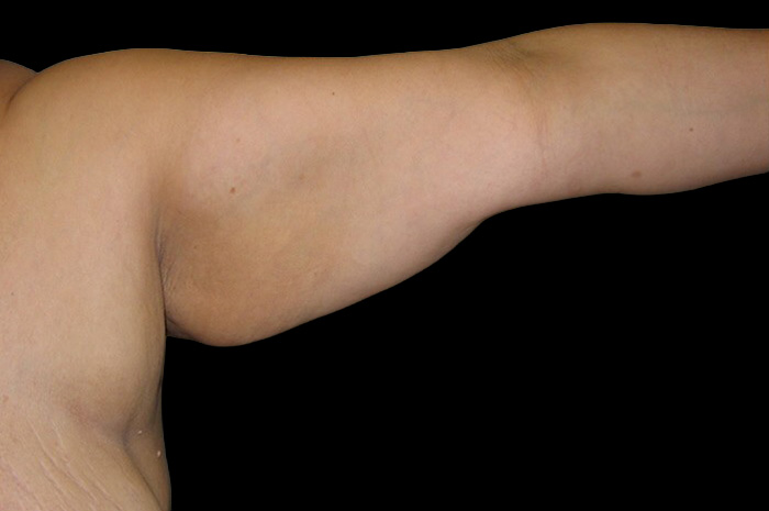 Case--4985 | Before Body