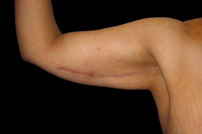 Case--6578 | After Arm Lift 2