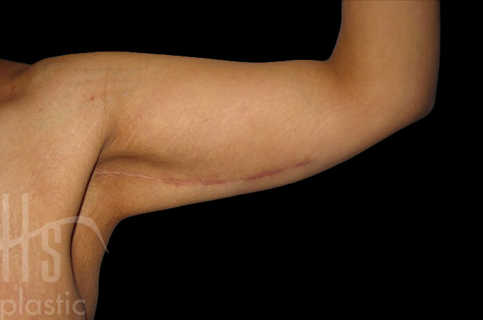 Case--6578 | After Arm Lift