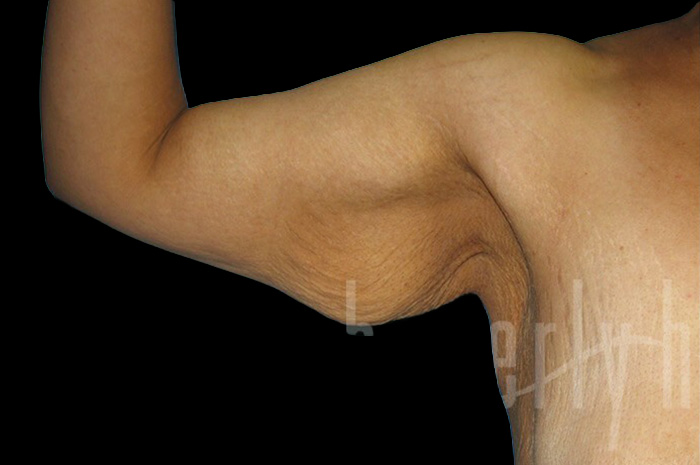 Case--6578 | Before Arm Lift 2