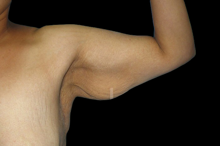 Case--6578 | Before Arm Lift