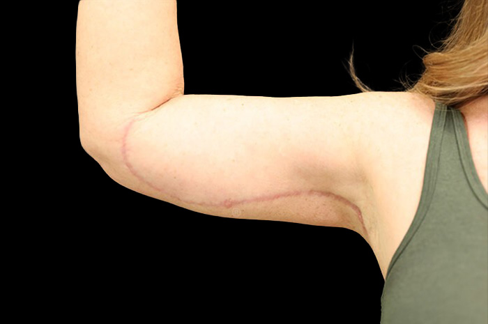 Case--1960 | After Arm Lift 2