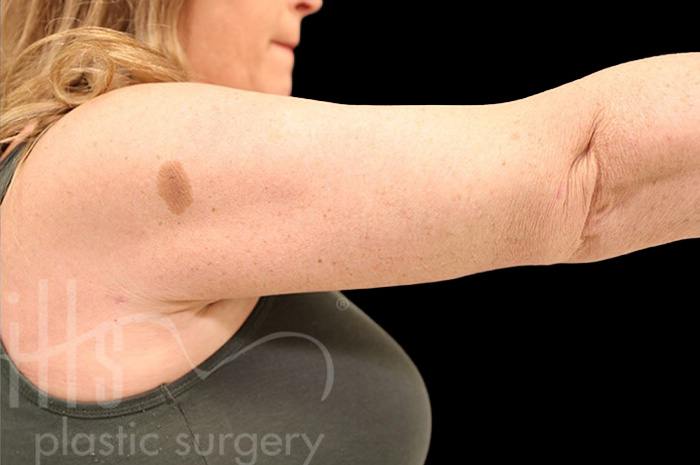 Case--1960 | After Arm Lift 3