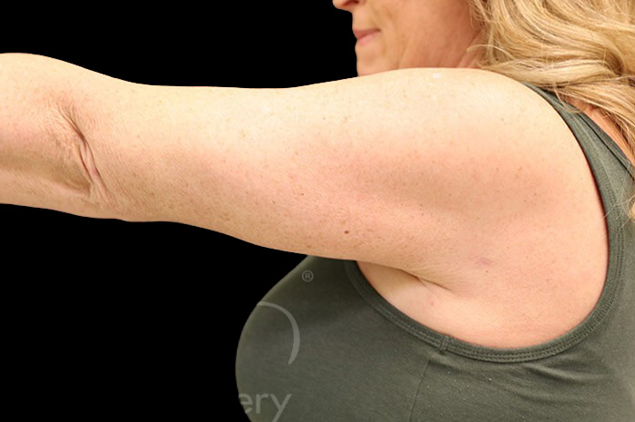 Case--1960 | After Arm Lift 4