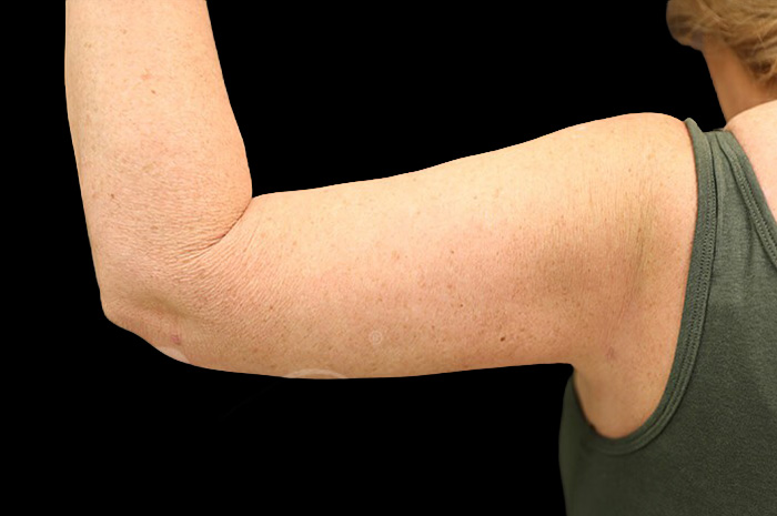 Case--1960 | After Arm Lift 5