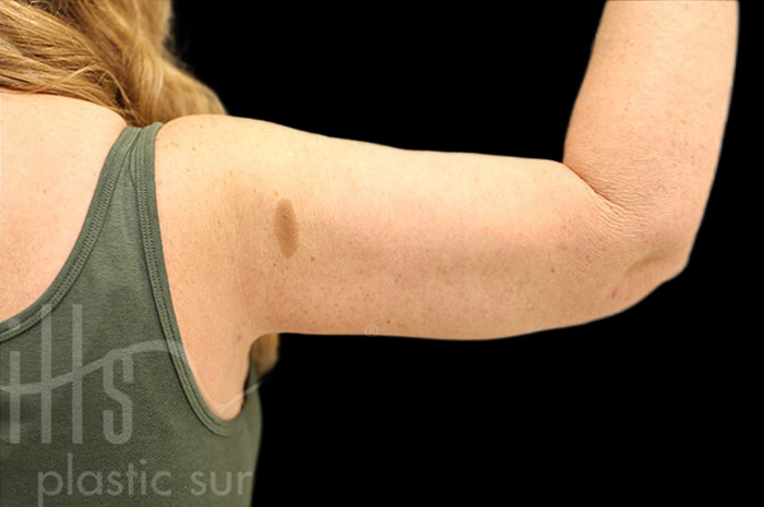 Case--1960 | After Arm Lift 6