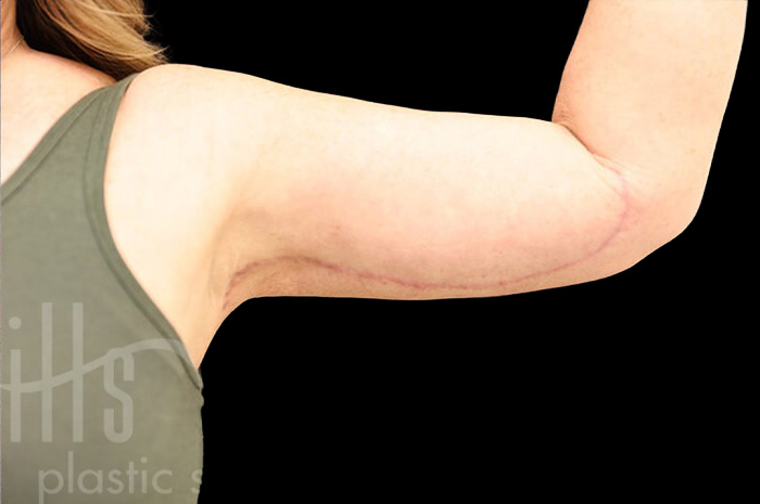 Case--1960 | After Arm Lift