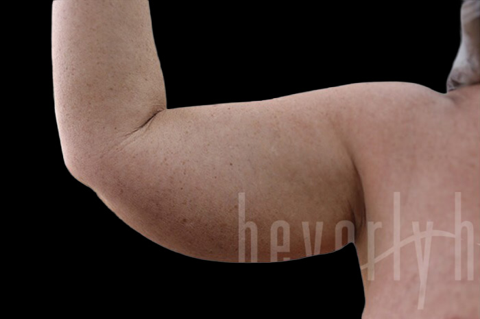 Case--1960 | Before Arm Lift 2