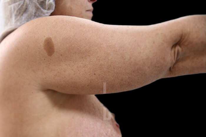 Case--1960 | Before Arm Lift 3