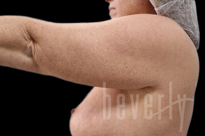 Case--1960 | Before Arm Lift 4