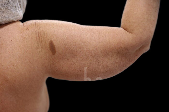 Case--1960 | Before Arm Lift 6