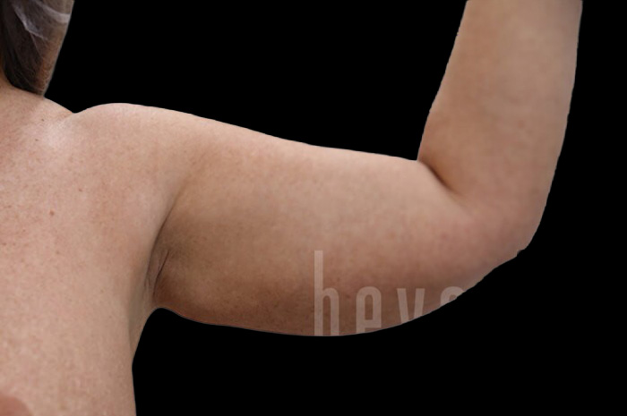 Case--1960 | Before Arm Lift