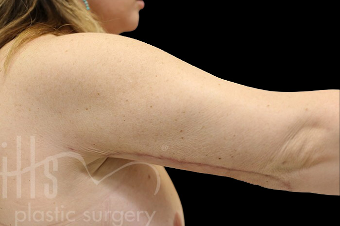 Case--1306 | After Arm Lift 2