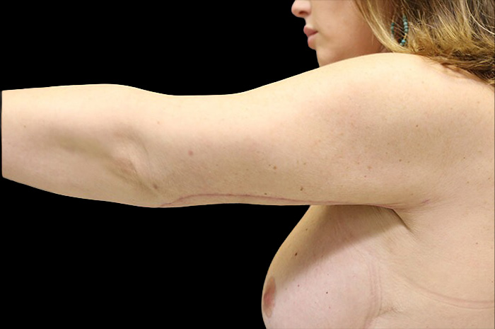 Case--1306 | After Arm Lift 4