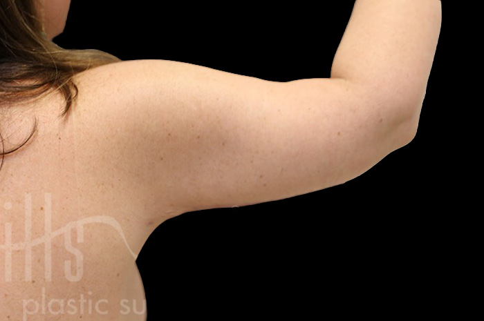 Case--1306 | After Arm Lift 5