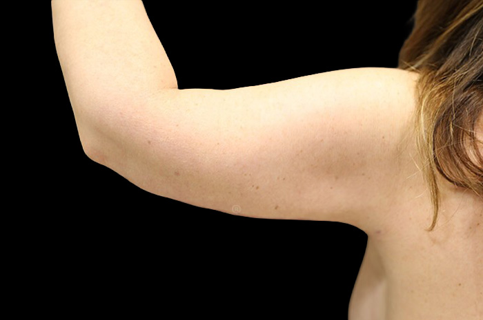 Case--1306 | After Arm Lift 6