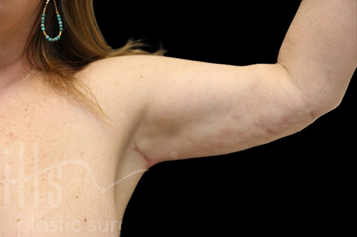 Case--1306 | After Arm Lift